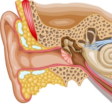Meniere's Disease