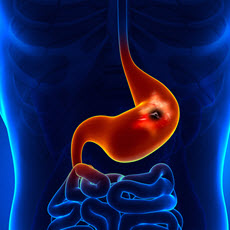 Peptic Ulcer