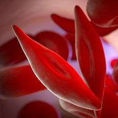 Sickle Cell Disease