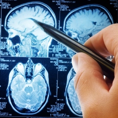 Tuberous Sclerosis