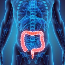 Ulcerative Colitis