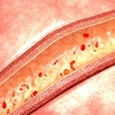 Vasculitis
