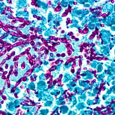 Yeast Infections