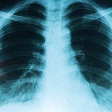 Lung Cancer