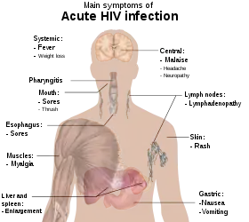 A diagram of a human torso labeled with the most common symptoms of an acute HIV infection