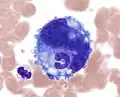 Emperipolesis: a band neutrophil inside a megakaryocyte (Wright-Giemsa, 100x, oil).