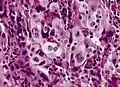 Large cell carcinoma.
