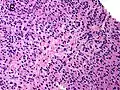 Gleason score 10 (5+5) with cords of cells