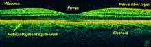 Time-Domain OCT of the macular area of a retina at 800&nbsp;nm, axial resolution 3&nbsp;µm