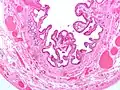 Micrografía de colesterolosis de la vesícula biliar