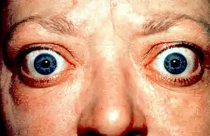 Proptosis_and_lid_retraction_from_Graves'_Disease