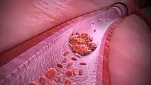 Animación médica Trombofilia