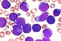 Leucemia