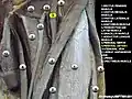 Arteria femoral en una disección.