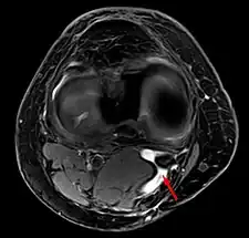 quiste de Baker en  MRI axial con comunicación entre el músculo semimenbranoso y el  the músculo gastrocnemius.