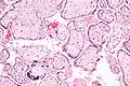 Placentitis por citomegalovirus (CMV)