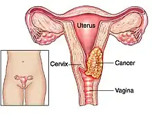 Cervical cancer