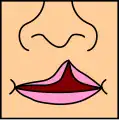 Unilateral incompleta