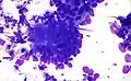 Adenocarcinoma colorrectal. Tinción de Field .
