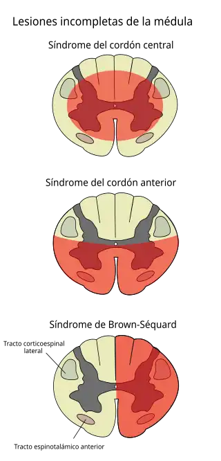 Lesiones incompletas de la médula