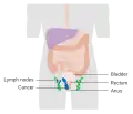 Etapa 3 del cáncer anal