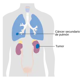 Cáncer de riñón en etapa 4