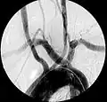 Angiografía mostrando arteria subclavia aberrante derecha