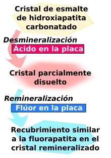 El cristal del esmalte de hydroxyapatita carbonatada es desmineralizado por el ácido en la plaqueta y se convierte en un cristal parcialmente disuelto. A su vez, éste es remineralizado por el fluoruro en la placa para convertirse en un revestimiento similar a la fluorapatita en el cristal remineralizado.