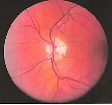 Vasos sanguíneos del ojo.