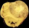 Una muestra patológica de un astrocitoma gemistocítico.