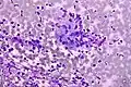 Granuloma. Tinción de Field .