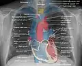 El contorno de la vena cava superior en una radiografía de tórax está etiquetado a la izquierda.