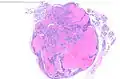 Cistoadenolinfoma (tumor de Warthin) de una parótida.