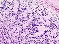 Schwannoma periférico Antoni tipo A