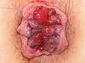 Hemorroides grado 4