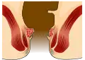 Hemorroides grado 1