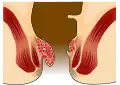 Hemorroides grado 2
