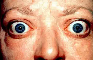 Proptosis_and_lid_retraction_from_Graves'_Disease