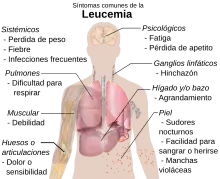 Síntomas de la leucemia.
