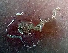 Galería excavada por un arador de la sarna, que se desplazó hacia la parte superior-derecha. Los grandes eritemas a la izquierda son por rascado.