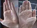 Descamación de la piel en las manos, causada por la fiebre escarlata.