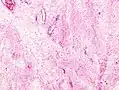 Schwannoma subcutaneo Antoni B