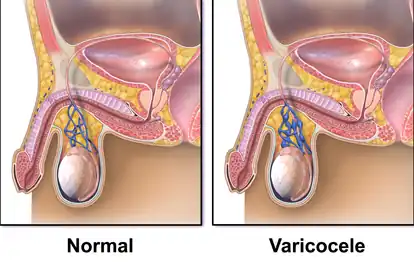 Varicocele