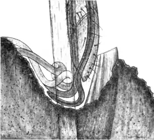 Tropical Diseases - Fig 105.png