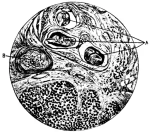 Tropical Diseases - Fig 113.png