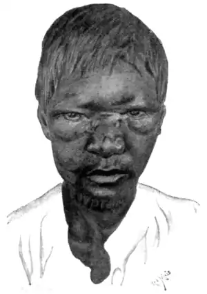 Tropical Diseases - Fig 214.png