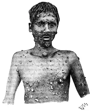 Tropical Diseases - Fig 90.png