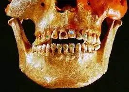 teeth with jewel inlays