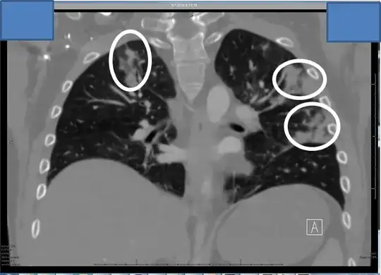My fungal pneumonia