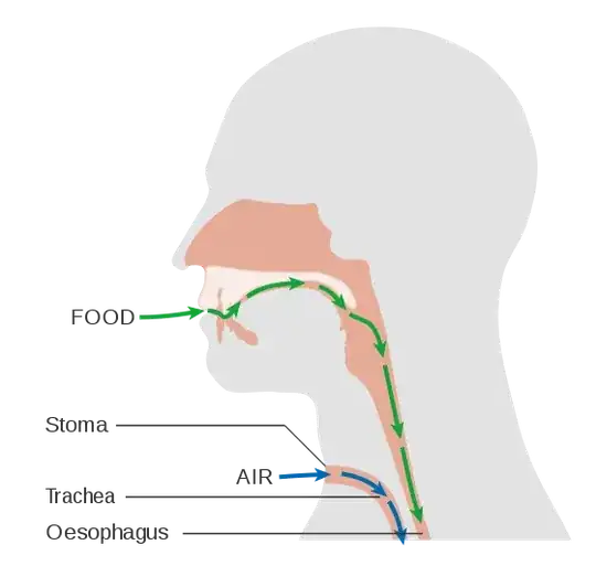 laryngectomy